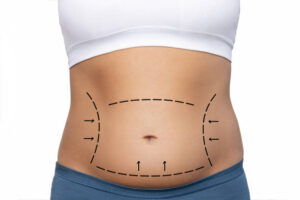 What Makes Liposuction a Popular Body Solution