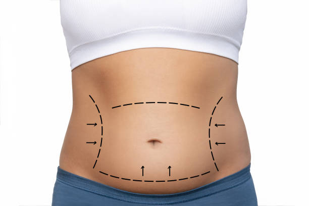 What Makes Liposuction a Popular Body Solution