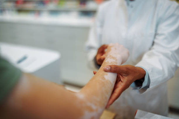 What age is ideal for vitiligo treatment care