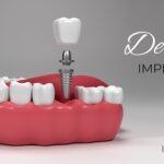 Affordable Dental Implants Sydney