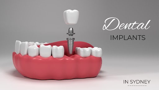 Affordable Dental Implants Sydney