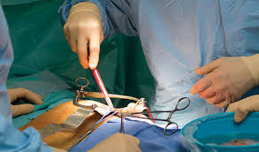 kidney transplant surgery