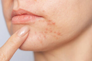 Can Laser Acne Scar Treatment Tighten Skin Too