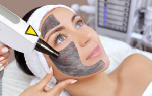 Can Laser Carbon Peel Remove Blackheads Fast