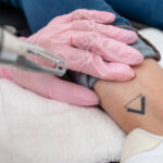 Can Tattoo Removal Remove Stubborn Black Ink