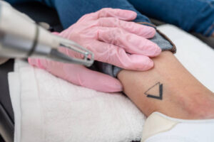 Can Tattoo Removal Remove Stubborn Black Ink