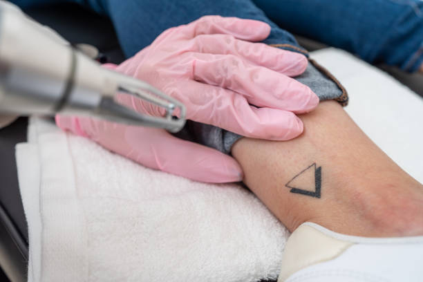 Can Tattoo Removal Remove Stubborn Black Ink