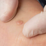 Can Wart Removal Improve Skin Appearance Quickly