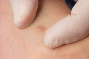 Can Wart Removal Improve Skin Appearance Quickly
