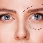 Chirurgie des paupières à Paris