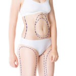 Does Liposuction Tighten Loose Skin Too