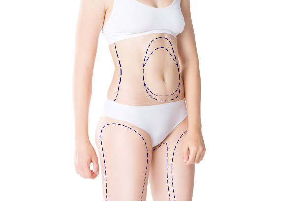 Does Liposuction Tighten Loose Skin Too
