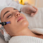 Does Microneedling Help Fade Stretch Marks Quickly