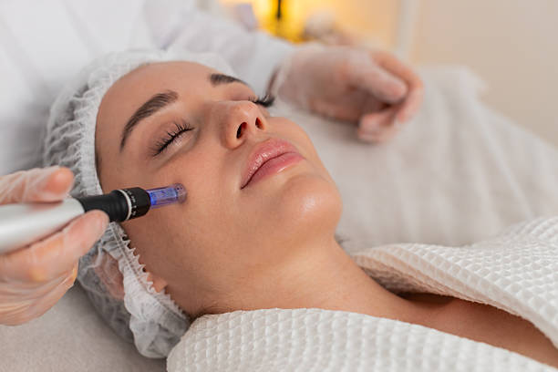 Does Microneedling Help Fade Stretch Marks Quickly