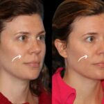 Sculptra in dubai