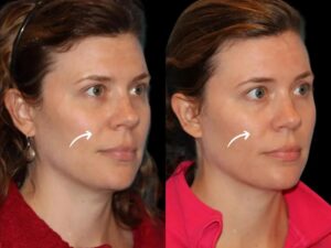 Sculptra in dubai