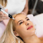 How Effective Is RF Microneedling for Fine Lines