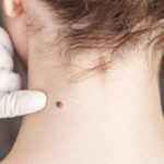 Is Skin Tag Removal Suitable for All Skin Types