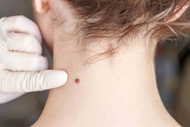 Is Skin Tag Removal Suitable for All Skin Types