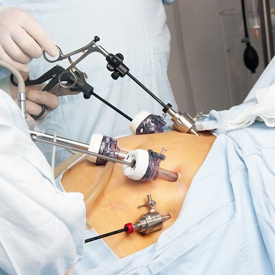 Laparoscopic surgery in Islamabad Pakistan