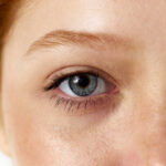 What Makes Eye Bag Removal a Trusted Treatment