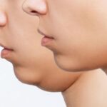 lifting facial sin cirugía