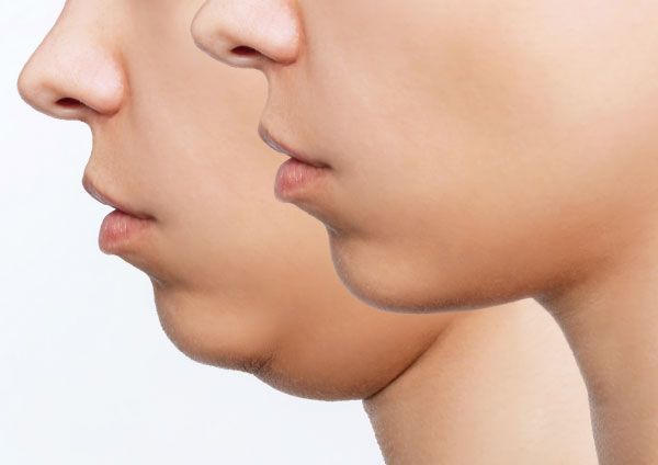lifting facial sin cirugía
