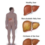 fatty liver treatment