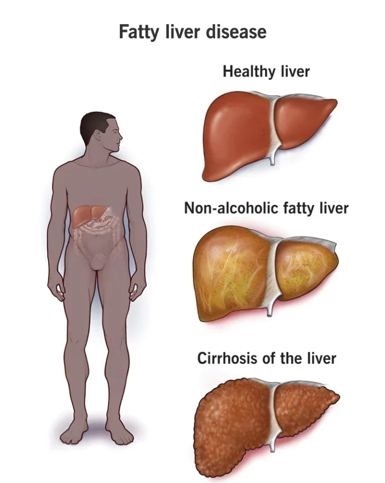 fatty liver treatment