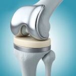 Knee Replacement in India