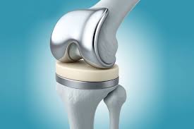 Knee Replacement in India