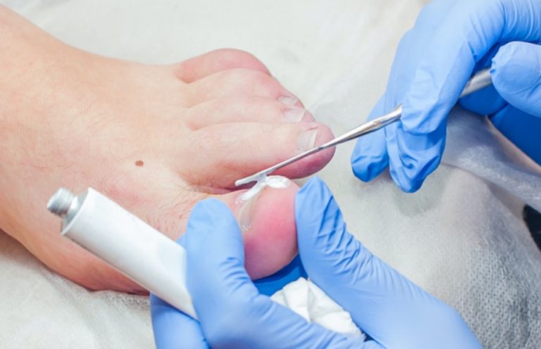 Chemical Matricectomy in Townsville