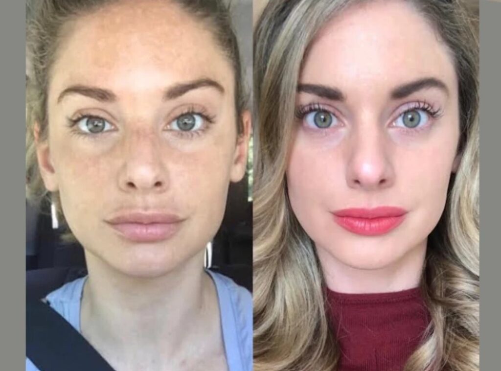 Radiofrequency (RF) Microneedling in Dubai