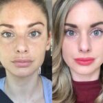 Radiofrequency (RF) Microneedling in Dubai