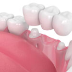 dental-bridges