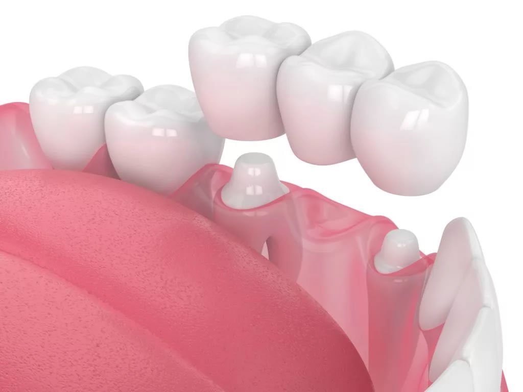 dental-bridges