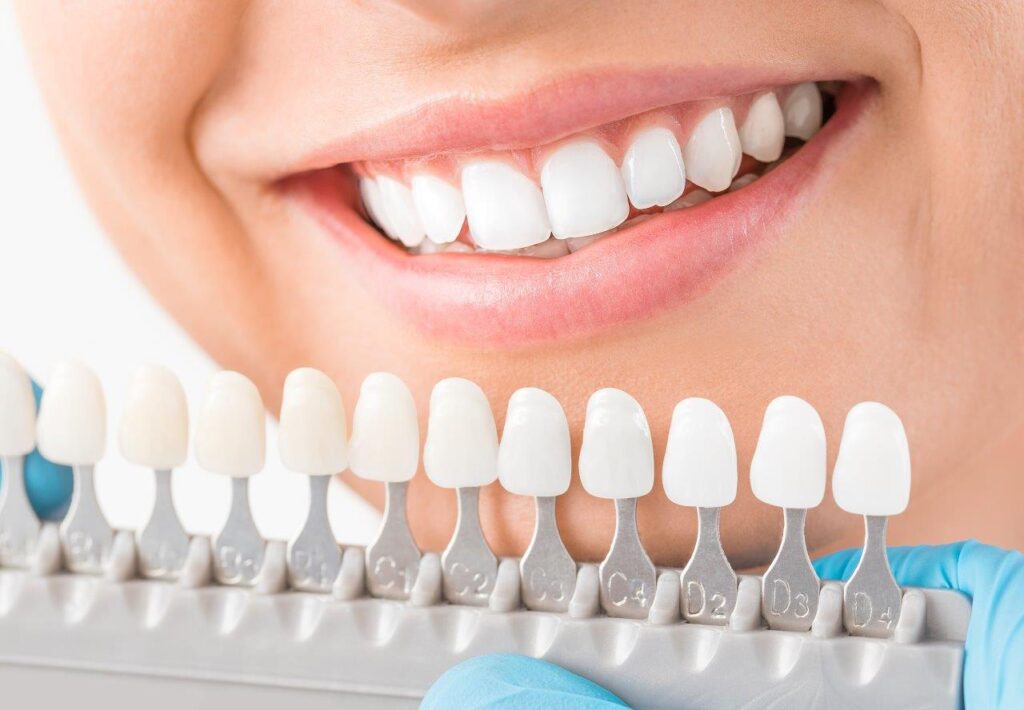 Veneers Dubai