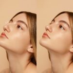 Rhinoplasty Before and After