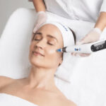 microneedling Edmonton Alberta