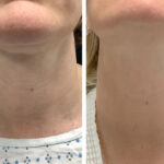 Best Doctors in dubai Offering RF Microneedling for Youthful Skin