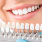 dental-veneers-clinic-dubai