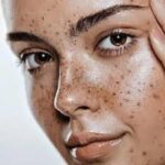 Melasma In Manchester