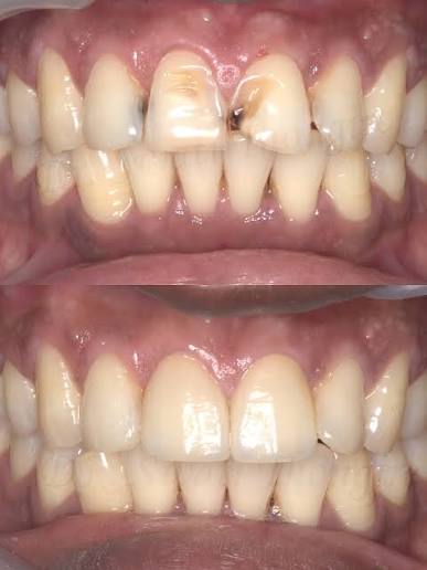 Root Canal Specialist