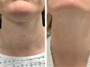 Best Aesthetic Clinics in dubai for Radiofrequency Microneedling Skin Repair