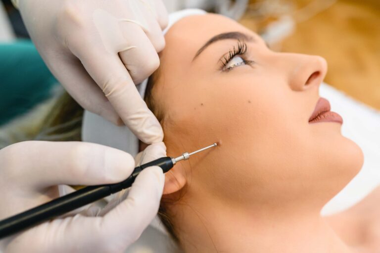 mole-removal
