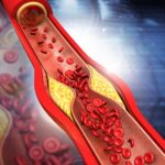 Angioplasty & Stent in Chandigarh
