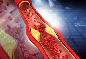 Angioplasty & Stent in Chandigarh