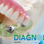 Dental Aligners Cost: Clear Aligner Prices & Treatment Details