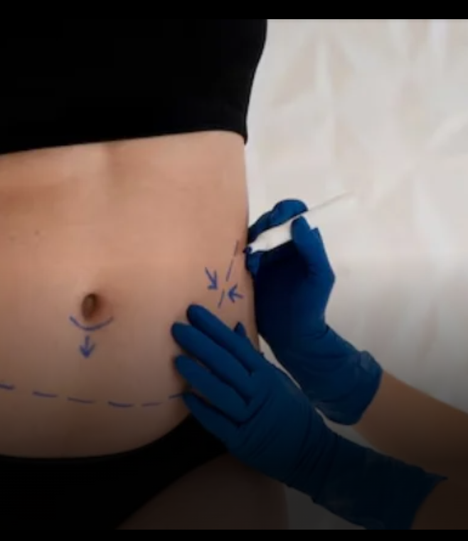 Abdominoplasty In Dubai