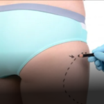 buttock